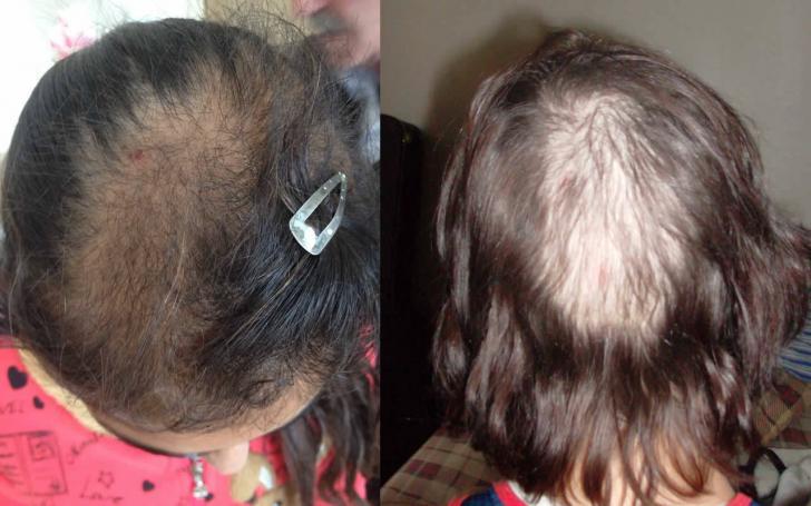 Çocuklar neden saçlarını yerler? Saç yeme hastalığı nedir? | Hasta Çocukların kafa fotoğrafları
