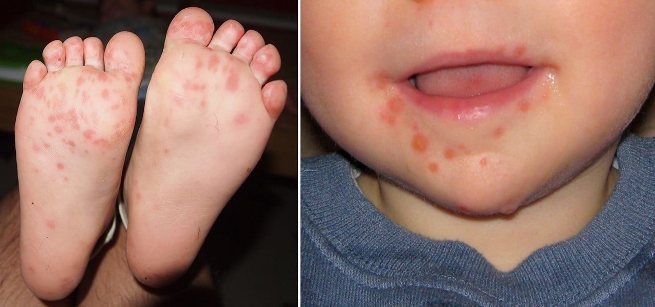 Çocuklarda el ayak ağız hastalıkları neden olur? | Ağız ve Ayak kızarıklıkları
