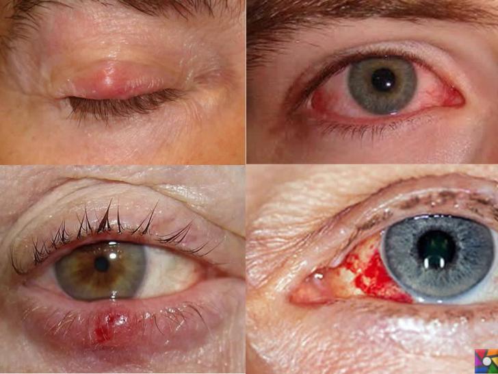 Deri ve Mukoza Yolu ile Bulaşan Hastalıklar Nelerdir? Belirtileri ve Tedavisi | Trahom Göz mukozası hastalığıdır.
