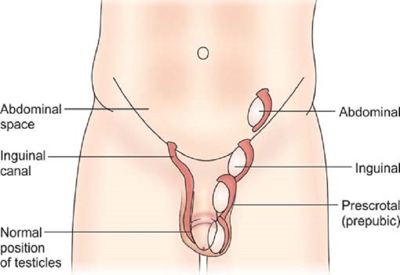 Erkek Bebek Hastalığı: İnmemiş Testis Nedir? Teşhisi, Belirtileri, Tedavisi | Testisin hormon tedavisi ile indirilmesi