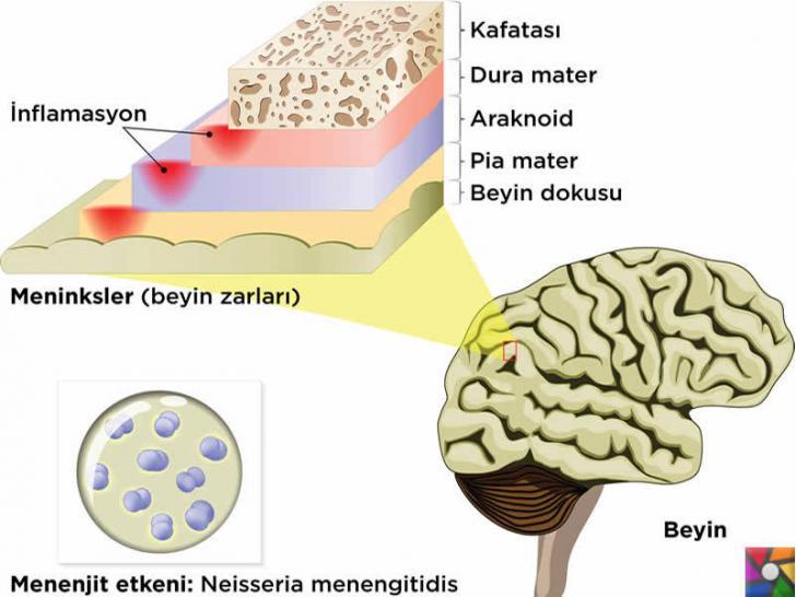 Hava yoluyla insanlara bulaşan hastalıklar nelerdir? Belirtileri ve Tedavisi | Menenjit beyin fonksiyonlarını etkiler.