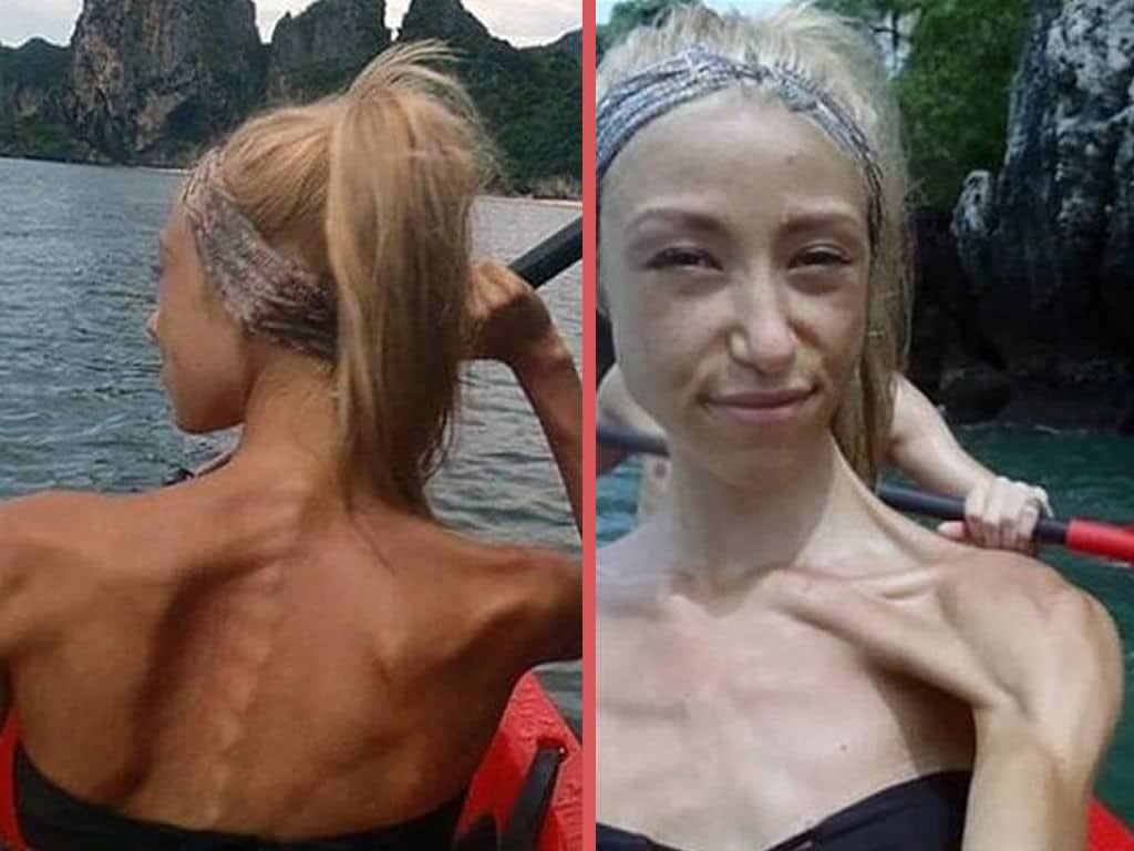 Anoreksiya nedir Anoreksiya belirtileri nelerdir Anoreksiya nedir Anoreksiya belirtileri nelerdir