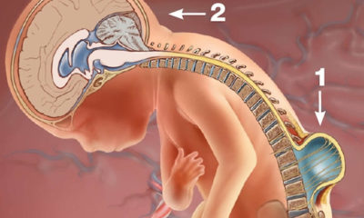 Spina Bifida Hastalılığı Nedir? Neden Oluşur? Tedavisi