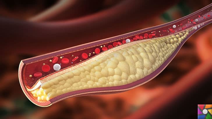 Kalp Krizi en çok Ağrı Kesici alma döneminde gerçekleşiyor! Kalbe giden arterlerde oluşan tıkanma