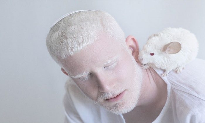 Albino nedir? Albino hastalığının sebepleri nelerdir?