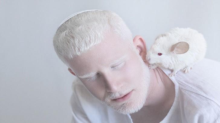 Albino Nedir? Albino Hastalığının Sebepleri Nelerdir?