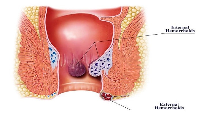 Basur (Hemoroid) Nedir? Korunma Ve Tedavi Yolları Nelerdir?