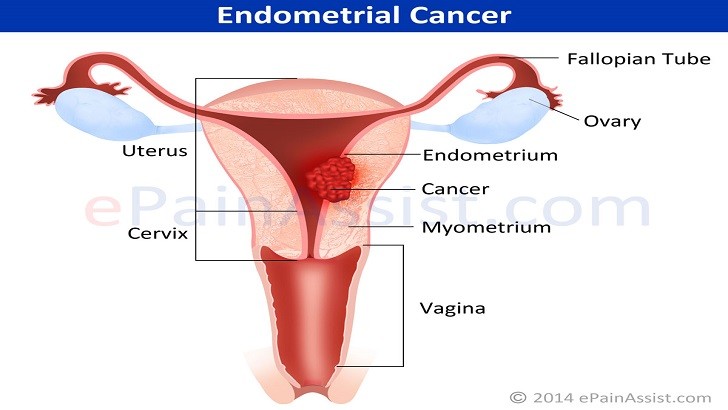 Lignan nedir? Lignanların Sağlığa Faydaları Nelerdir? Lignan Kaynakları Nelerdir? | Endometrial Kanseri