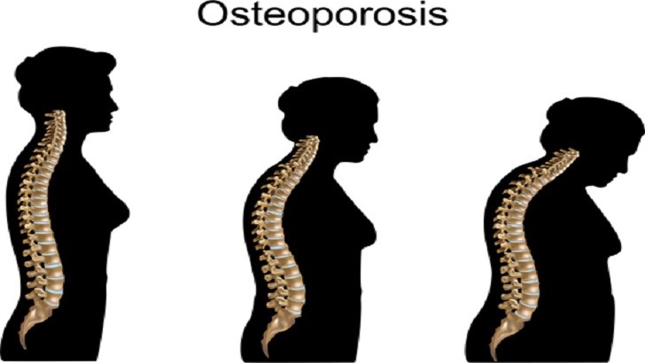 Lignan nedir Lignanların Sağlığa Faydaları Nelerdir? Lignan Kaynakları Nelerdir? | Osteoporoz Hastalığı gelişimi