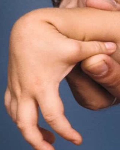 Botulism (Botulizm) nedir? Belirtileri nelerdir? Nasıl Tedavi edilir?