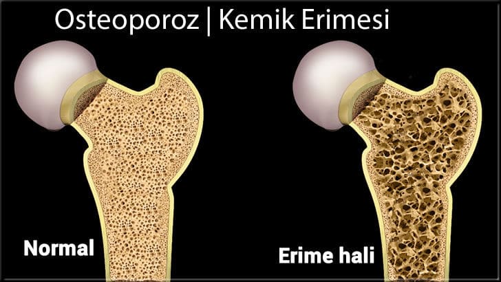 Kemik erimesi nedir? Kemik erimesinin nedeni Bağışıklık Sistemi mi? | Kemik erimesi, kalsiyum gelmeyen organların kemiklerin içindeki kalsiyum depolarını çekmesinden kaynaklanmaktadır