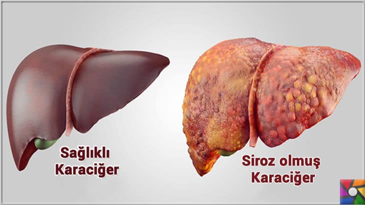 Enginar Zayıflatır mı? Enginarın yararları ve zararları nelerdir? | Kendini yenileyebilen harikulade bir hayati organ olan Karaciğer için dost bitkilerden biri Enginardır