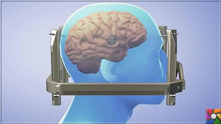 Gamma Knife Nedir? Gamma Knife Neden ve Nasıl Kullanılır? | Gamma Knife cihazına girmeden önce hastaya demir kafes takılır