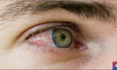 Göz kanlanması neden olur? Göz kanlanmasını gidermenin 21 etkili yolu