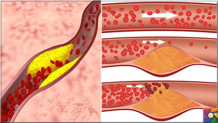 Damar Tıkanıklığı nedir, nasıl oluşur? Damar Tıkanıklığı nasıl tedavi edilir? | Damarların içindeki birikme zamanla kan dolaşımını engelliyor