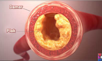 Damar Tıkanıklığı nedir, nasıl oluşur? Damar Tıkanıklığı nasıl tedavi edilir?
