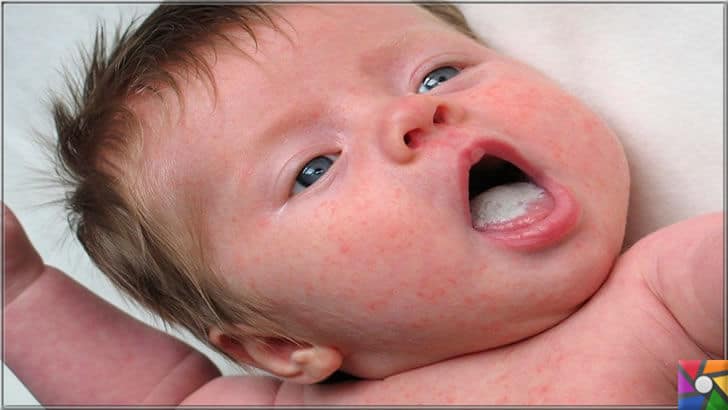 Yenidoğan döneminde rastlanan en sık hastalıklar nelerdir? | Konak hastalığı hemen hemen her bebekte görülebilir | Pamukçuk kolay tedavi edilebilen bir bebek hastalığıdır