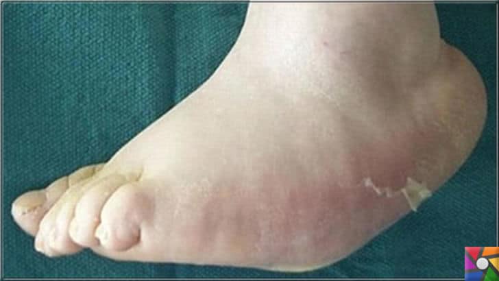 Diyabet hastaları neden ayak bakımına dikkat etmeli? | Charcot'un ayağı: Ayağınızdaki eklemleri ve yumuşak dokuyu tahrip eden sinir hasarı.