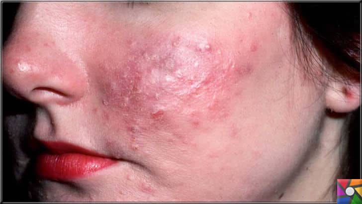 Probiyotikler sivilce, rosacea, egzama gibi deri hastalıklarını iyileştirebilir mi? | Rosacea yada Gül hastalığı