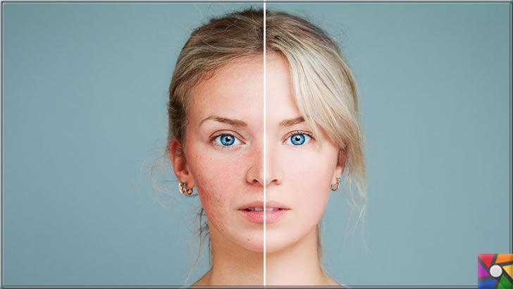 Probiyotikler sivilce, rosacea, egzama gibi deri hastalıklarını iyileştirebilir mi?