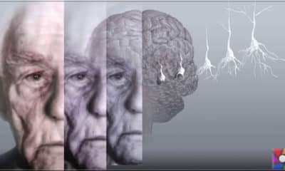 Demans (Bunama) ve Alzheimer arasındaki fark nedir?