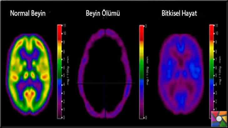 Beyin ölümü olduğunda beyin işlev durumu