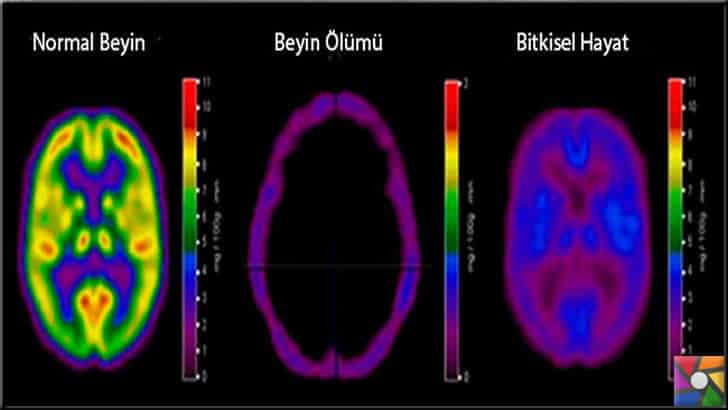 Beyin ölümü olduğunda beyin işlev durumu