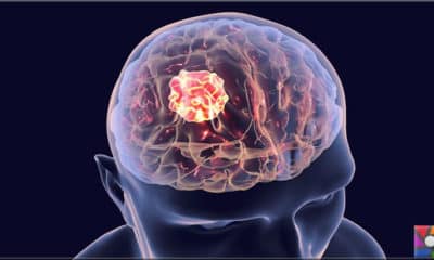 Beyin tümörü nasıl anlaşılır? Beyin tümörünün ilk belirtileri