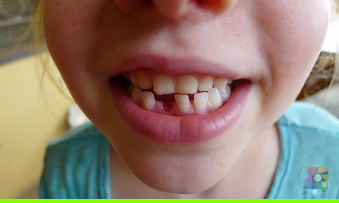 Diş protezi yerine kullanılacak diş tohumu ile dişlerimiz 3. kez çıkacak